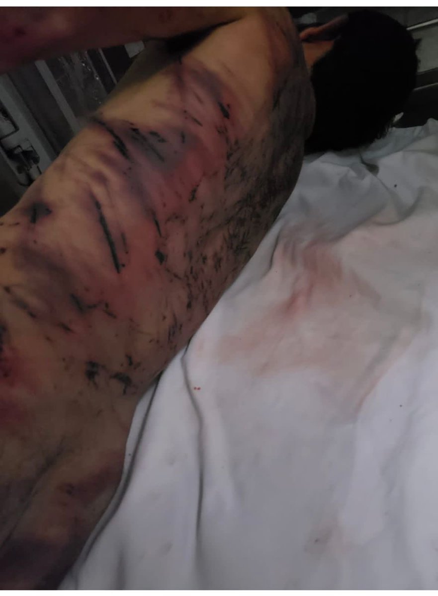 صور نشرها نشطاء حقوقيون لجثة شاب سوري قضى تحت التعذيب أثناء احتجازه في مديرية الأمن اللبنانية.