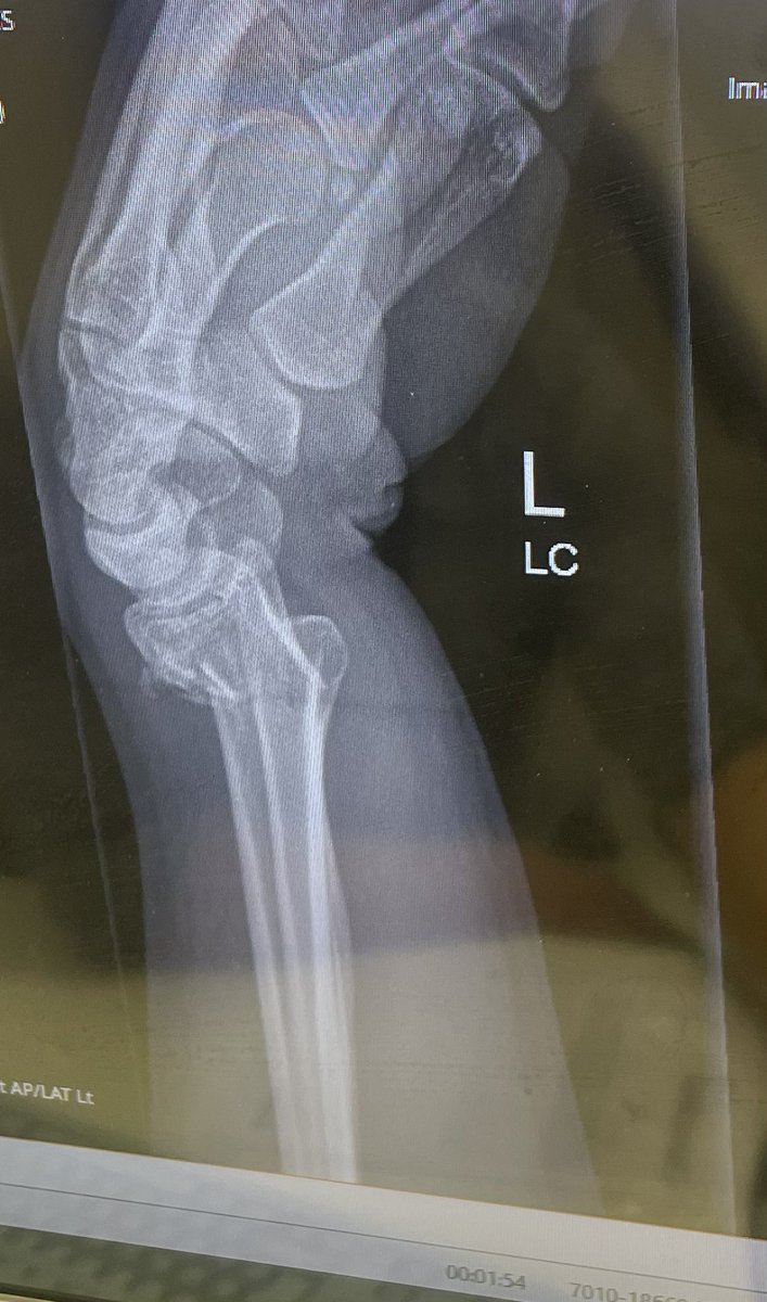 Stephgray10's tweet photo. After 7 weeks since my injury the cast is now off and I just want to say a huge Thankyou to @SRFTMajorTrauma for realigning my arm and doing such an amazing job and making my recovery as easy as possible.I am truly grateful for everyone I saw, now it’s time to smash the rehab💪🏻 https://t.co/clRSyzGhTd