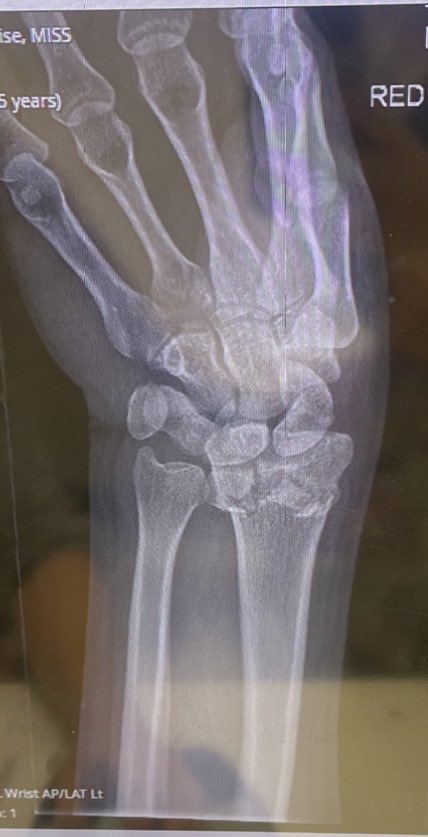 Stephgray10's tweet photo. After 7 weeks since my injury the cast is now off and I just want to say a huge Thankyou to @SRFTMajorTrauma for realigning my arm and doing such an amazing job and making my recovery as easy as possible.I am truly grateful for everyone I saw, now it’s time to smash the rehab💪🏻 https://t.co/clRSyzGhTd
