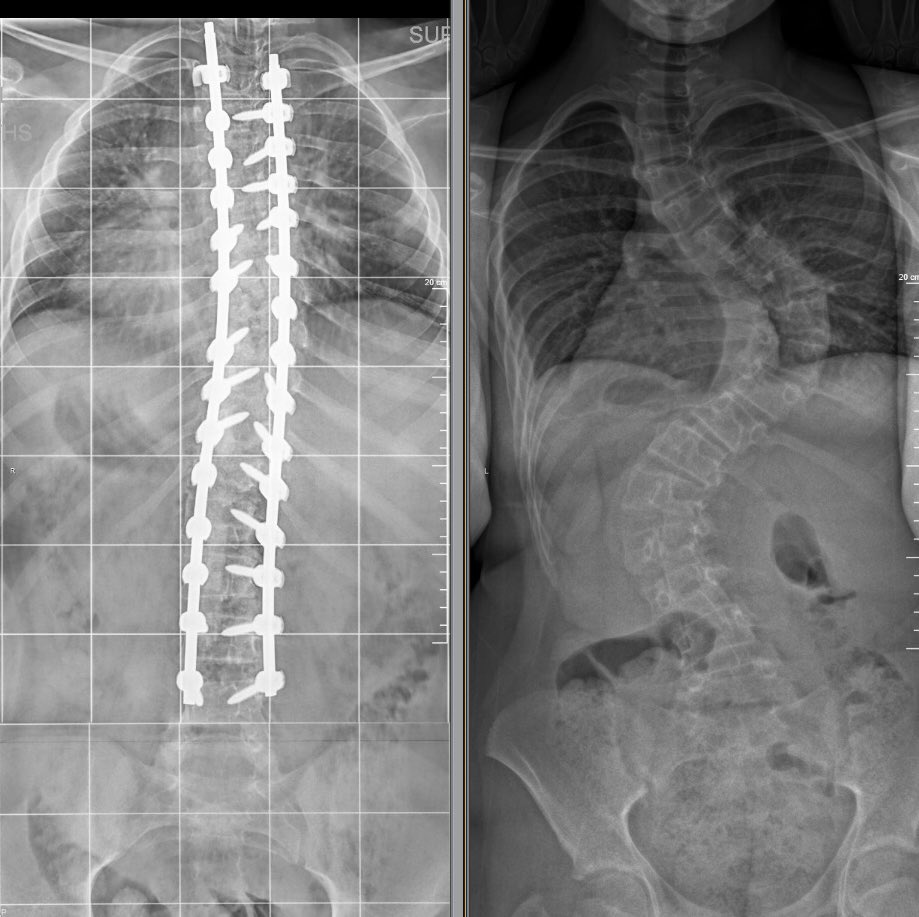 Came back to a big week of cases after spending some time with the family in Hawaii. This one was the toughest one but most satisfying. International patient who had a very large curve and no one in her home country that could treat it. Happy with how it turned out! #orthotwitter
