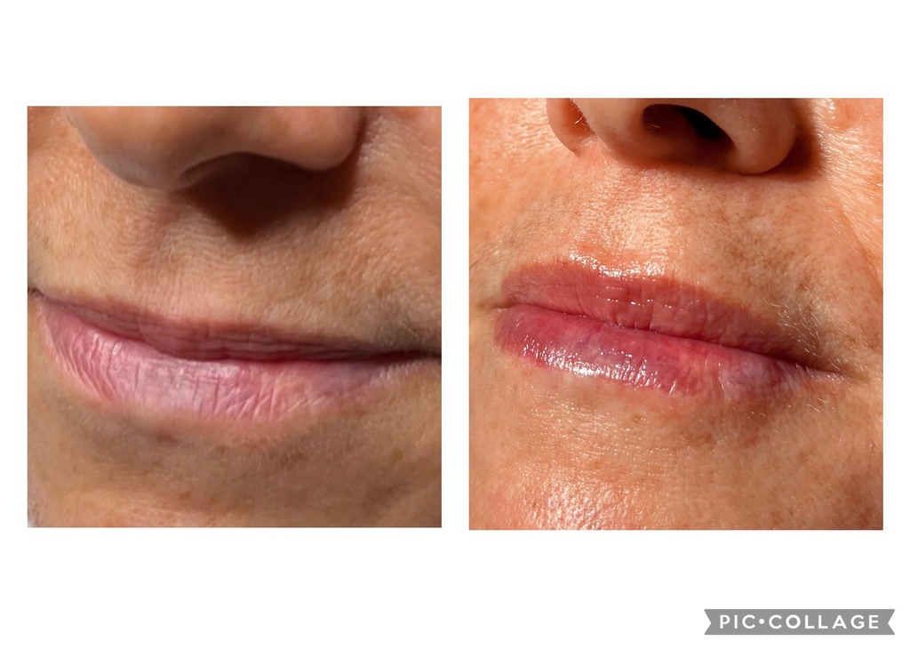 Who says Lip Filler can’t look natural? 
Contact us for a bespoke treatment tailored to you! 

#lipfiller #naturalaesthetics #smalltoplip #wrexham #whitchurch #shropshire #cheshire #ellesmere #wem #nantwich