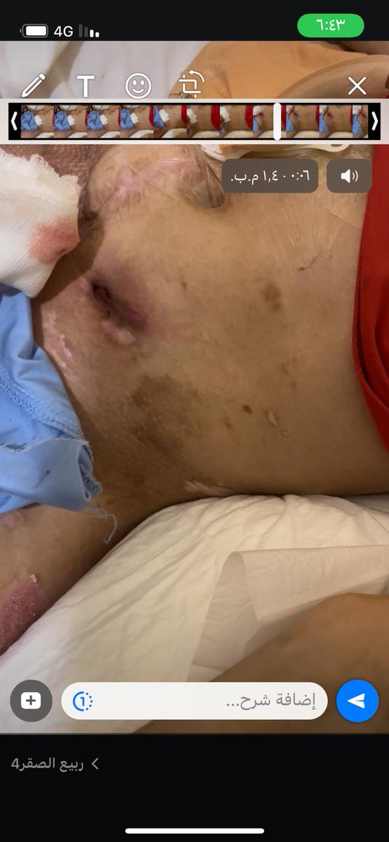 نحن لم نبحث عن الشهره لنا اولاحمد نبحث عن علاج عن مشفى يتبنى حالة احمد بكل مافيها ولم نبحث عن المال لان اصحاب الخير موجودين واخص بالذكر اخي فاعل الخير ابوابراهيم اللذي لم يتأبى ابدا في اي طلب واطباء جراحة التجميل جزاهم الله خيرا عملو بكل انسانيه ولكن احمديتالم #دعواتكم_للبطل_احمد