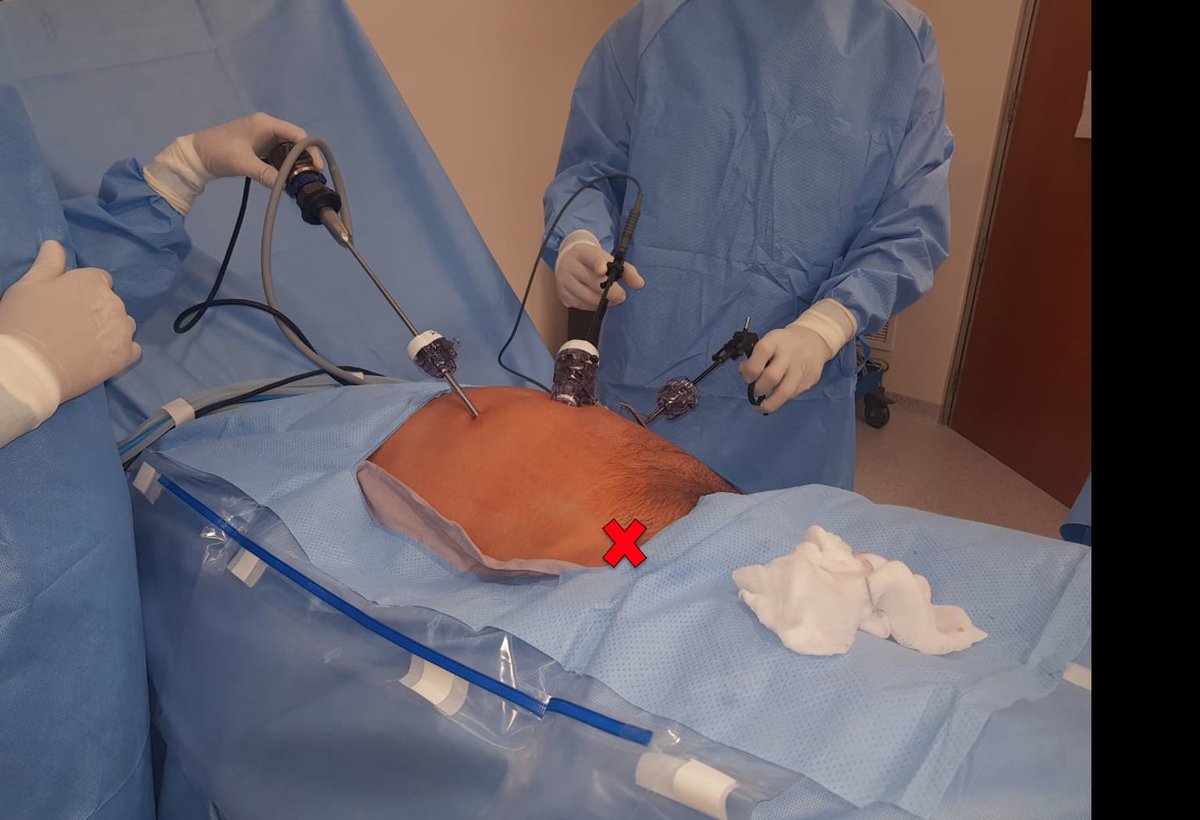 herniacntercdmx's tweet photo. TAPP: Lente de 5 mm sobre el mismo lado de la hernia (camarógrafo no estorba al cirujano); cirujano con ambas manos trabajando de forma más ergonómica contralateral a la hernia. ¿Ustedes cómo lo hacen? https://t.co/QNbKy8sGUe