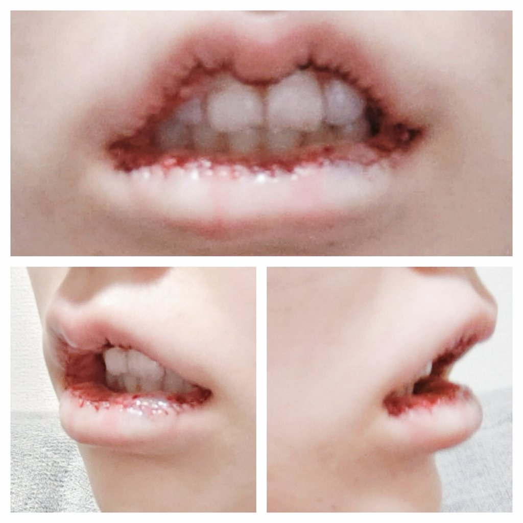 wg13055's tweet photo. 久し振りに整形したので経過レポします。口唇縮小で唇を薄く、立体的(M字リップ)にお願いしました。当日麻酔切れてから痛み止めが効くまで凄く痛かったです。腫れも酷く鼻の下が特にパンパンで、飲み物は零しながら何とか飲めます。ストローは吸えません。
１枚目：術前
２枚目：当日夜
３枚目：二日目 https://t.co/zyiQFBEt0H