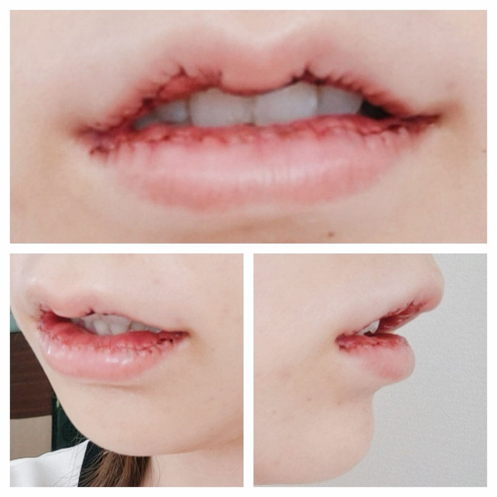 wg13055's tweet photo. 久し振りに整形したので経過レポします。口唇縮小で唇を薄く、立体的(M字リップ)にお願いしました。当日麻酔切れてから痛み止めが効くまで凄く痛かったです。腫れも酷く鼻の下が特にパンパンで、飲み物は零しながら何とか飲めます。ストローは吸えません。
１枚目：術前
２枚目：当日夜
３枚目：二日目 https://t.co/zyiQFBEt0H