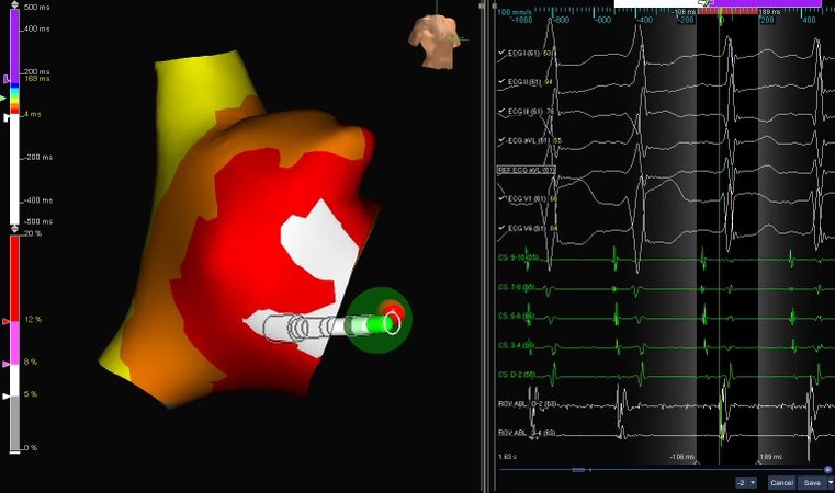 WPW mapped with #HDGrid allowed us to see fusion in two distinct areas to determine an early bifurcation of the pathway. Pre-excitation eliminated using #TactiCathSE