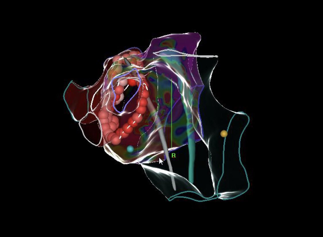 ALFIEEP1's tweet photo. Right lateral view of an anterior TSP and a posterior TSP.
The anterior TSP is the worst enemy for good CF. https://t.co/F98mWaaKIM