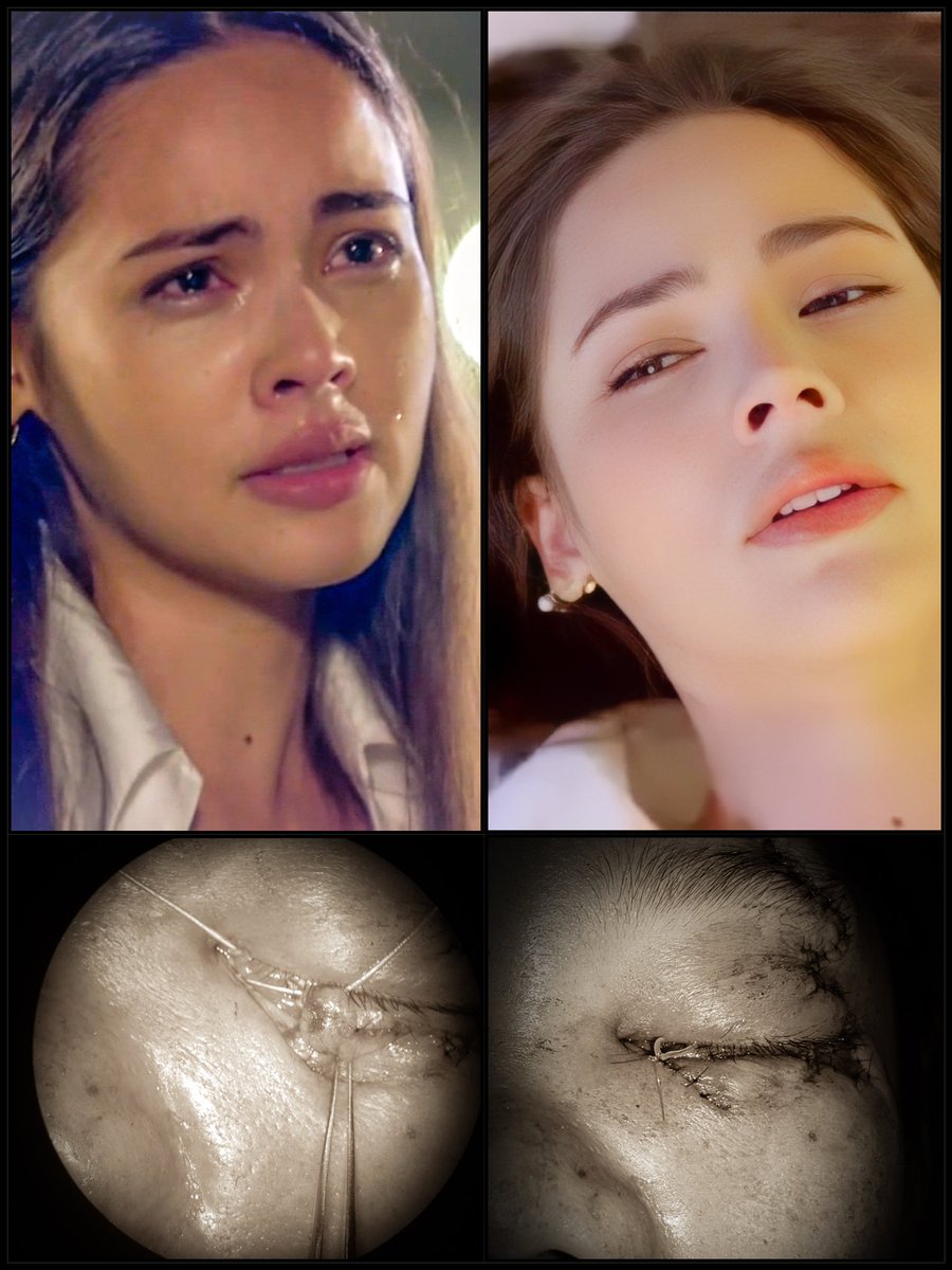 DrSatitW's tweet image. สาเหตุหนึ่งของภาวะน้ำตาไหลเอ่อ (Epiphora) เกิดจากการบาดเจ็บของทางเดินน้ำตา การรักษามีทั้งรักษาแบบผ่าตัดและไม่ผ่าตัด ขึ้นกับความเหมาะสม

ส่วนของญาญ่านั้น เป็น emotional crying 
เป็นสิ่งที่เกิดขึ้นตามปกติครับ
(ผมกลายเป็น FC เต็มตัวละ🥹)

#epiphora #eyelidinjury 
#คือเธอ #BadRomeo