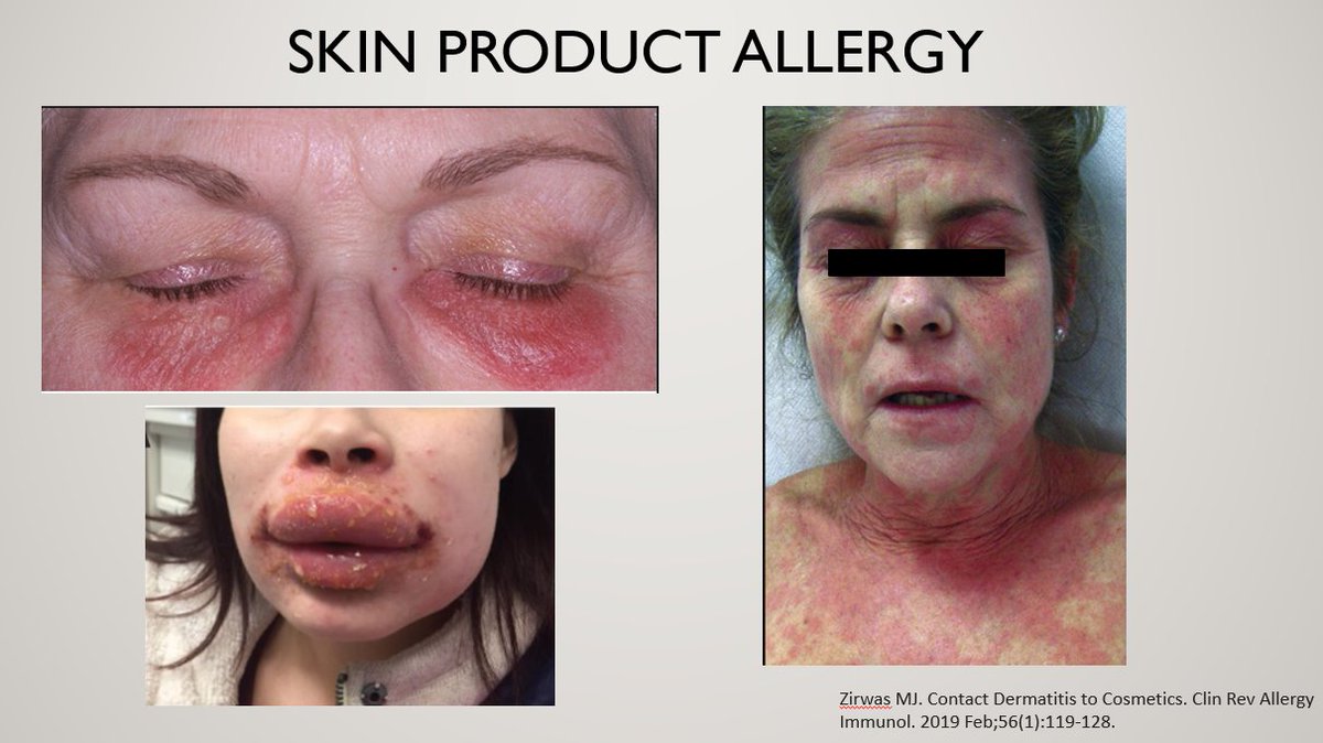 Dr_Aween_LiaNa's tweet image. TIPS KENALPASTI JIKA ANDA ALAH PRODUK KULIT BARU

Hello orang ramai!

Ramai pesakit saya alah teruk kpd produk kulit baru. Merah, menggelupas, bengkak, berair. Kesian, sbb dah habis beratus ringgit beli, tiba-tiba allergic. 

Jom belajar cara utk elakkan perkara ini berlaku jom!