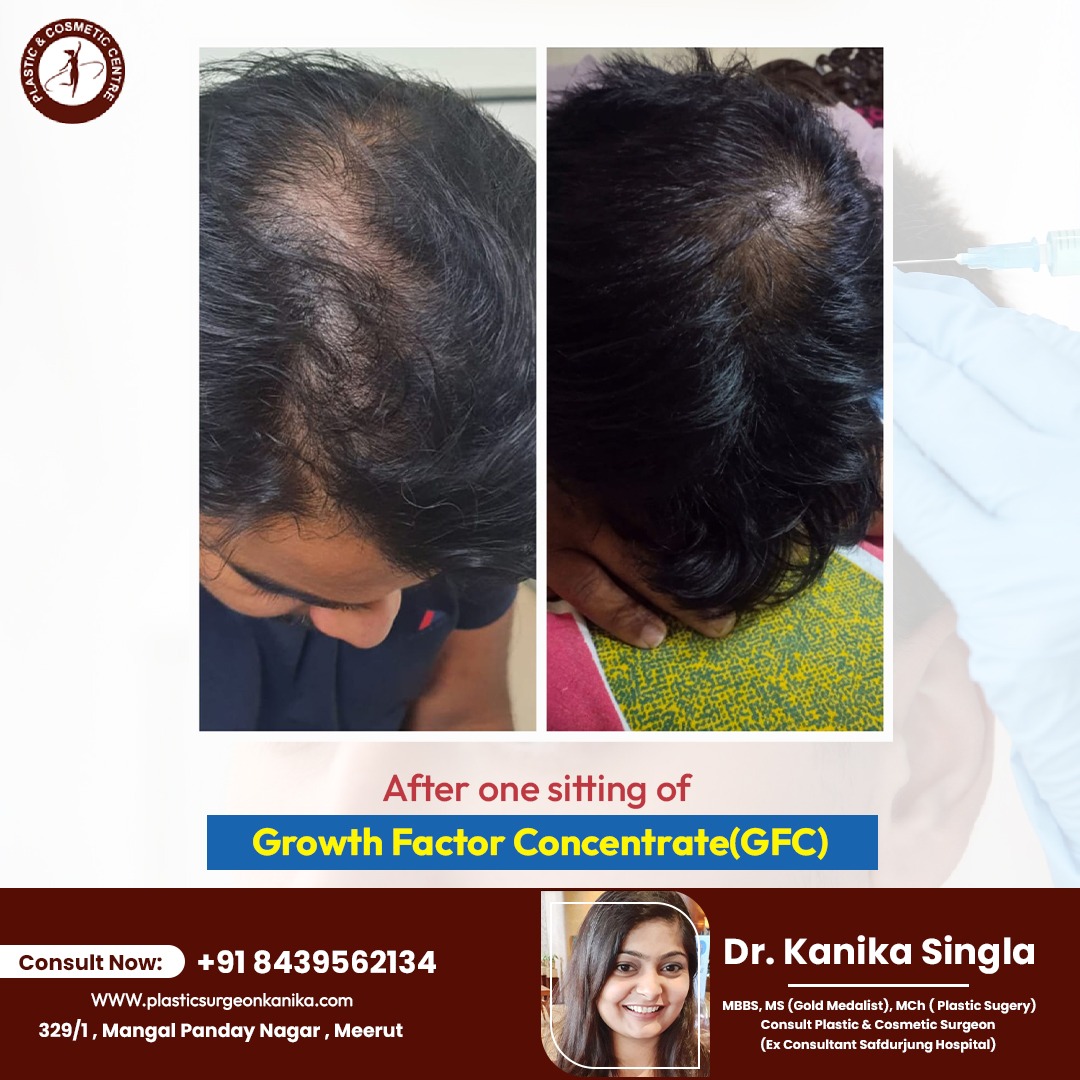 kanika_singla87's tweet photo. After one sitting of #growthfactorconcentrate (GFT).
Consult the expert today!
for more info : +91 84395 62134 Visit us: https://t.co/UrxGnvVmXm
#drkanikasingla #Plasticsugery #plasticsurgeon #surgeon #plastic #Cosmetic #facialimplants #ChinAugmentation_Surgery https://t.co/MqnzjKnimu