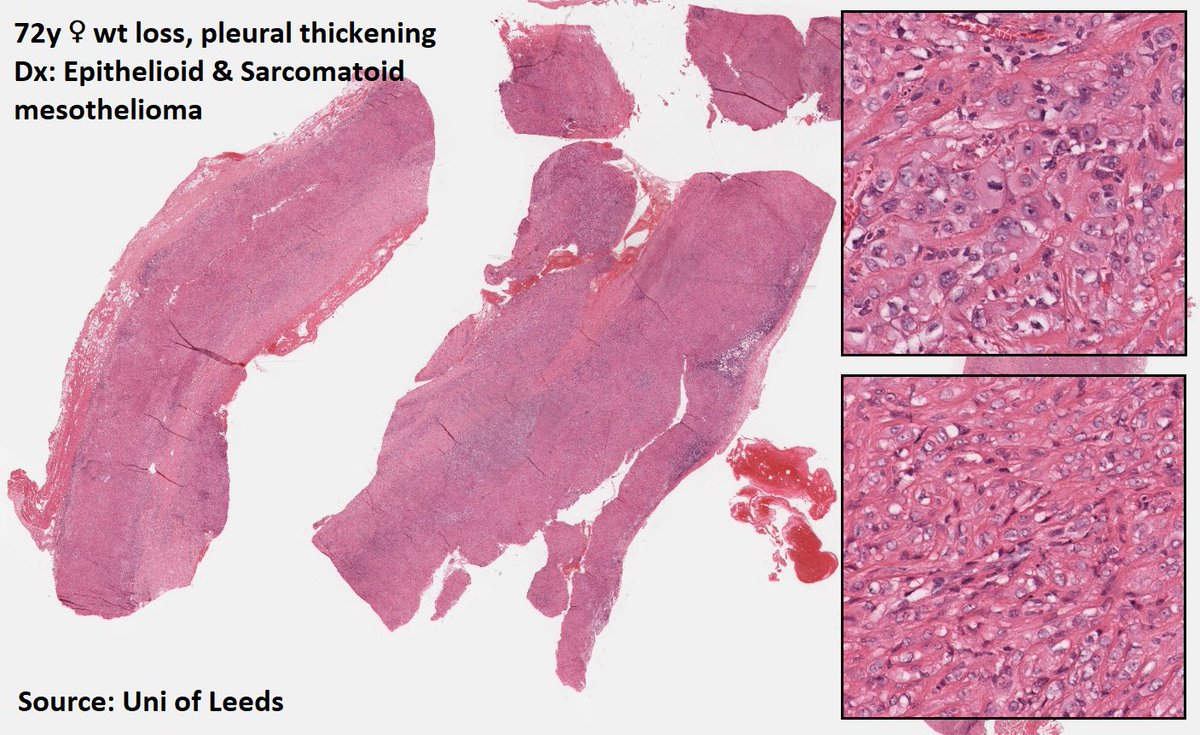 DrTravisBrown's tweet photo. Histology flash card
Mesothelioma
Rare
Majority >60yrs
Hx of asbestos exposure
Accelerated by 🚬
Presentation
Gradual onset chest pain, dyspnoea, hoarseness, night sweats, dysphagia
Imaging: pleural thickening
Dx biopsy
Ep8 #ThisPathLife #podcast
#MedTwitter
#PathTwitter https://t.co/FJJu1gNcdS