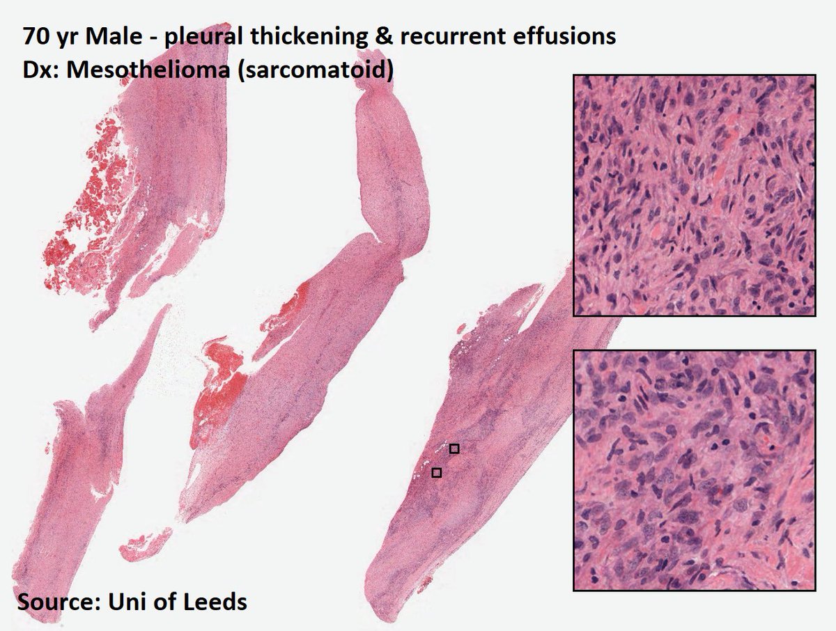 DrTravisBrown's tweet photo. Histology flash card
Mesothelioma
Rare
Majority >60yrs
Hx of asbestos exposure
Accelerated by 🚬
Presentation
Gradual onset chest pain, dyspnoea, hoarseness, night sweats, dysphagia
Imaging: pleural thickening
Dx biopsy
Ep8 #ThisPathLife #podcast
#MedTwitter
#PathTwitter https://t.co/FJJu1gNcdS