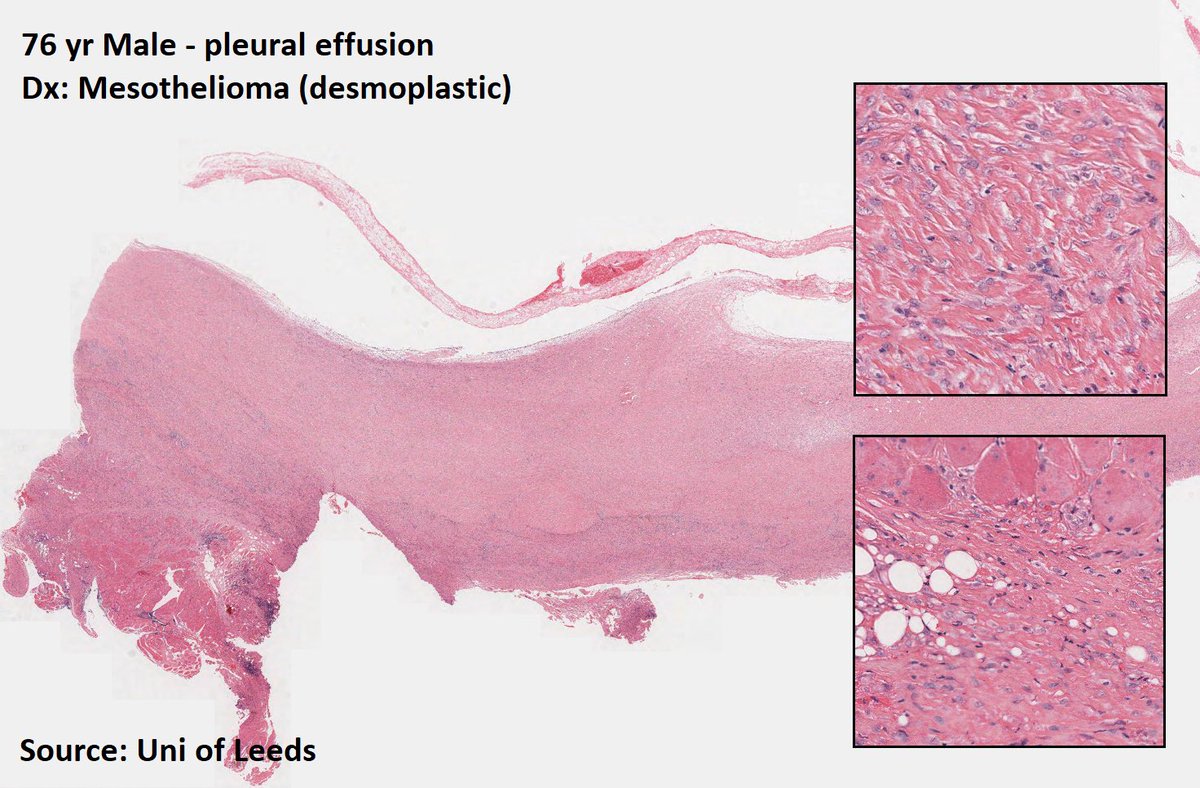 DrTravisBrown's tweet photo. Histology flash card
Mesothelioma
Rare
Majority >60yrs
Hx of asbestos exposure
Accelerated by 🚬
Presentation
Gradual onset chest pain, dyspnoea, hoarseness, night sweats, dysphagia
Imaging: pleural thickening
Dx biopsy
Ep8 #ThisPathLife #podcast
#MedTwitter
#PathTwitter https://t.co/FJJu1gNcdS