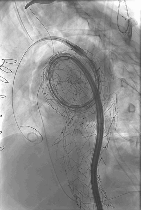 UMassVascSurg's tweet photo. There are tortuous vessels and then there are TORTUOUS vessels!!! https://t.co/UyWvBjvtEw