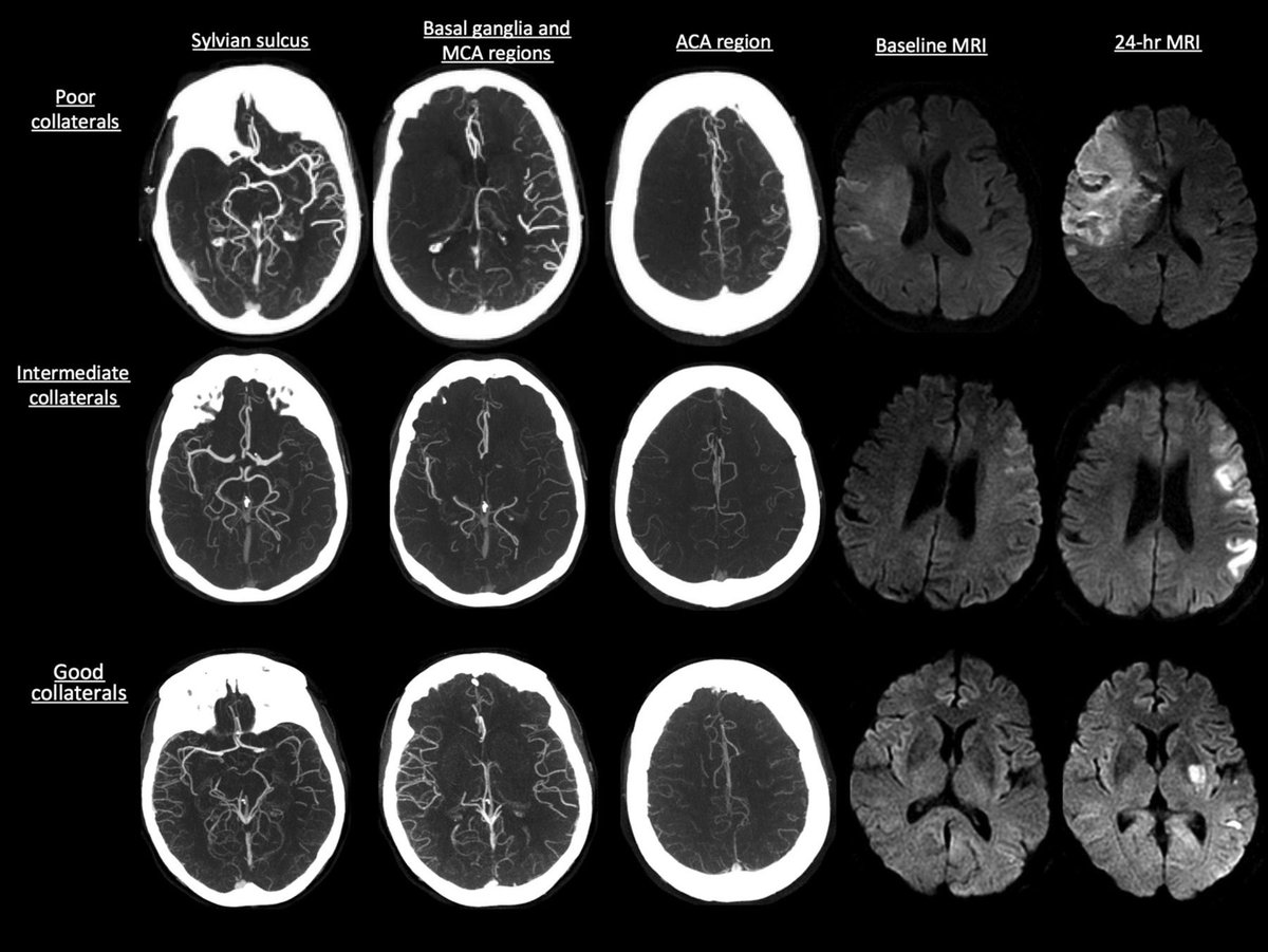 📌 Detection of Early Ischemic stroke Changes on NCCT and CTA

Here are a few examples:
