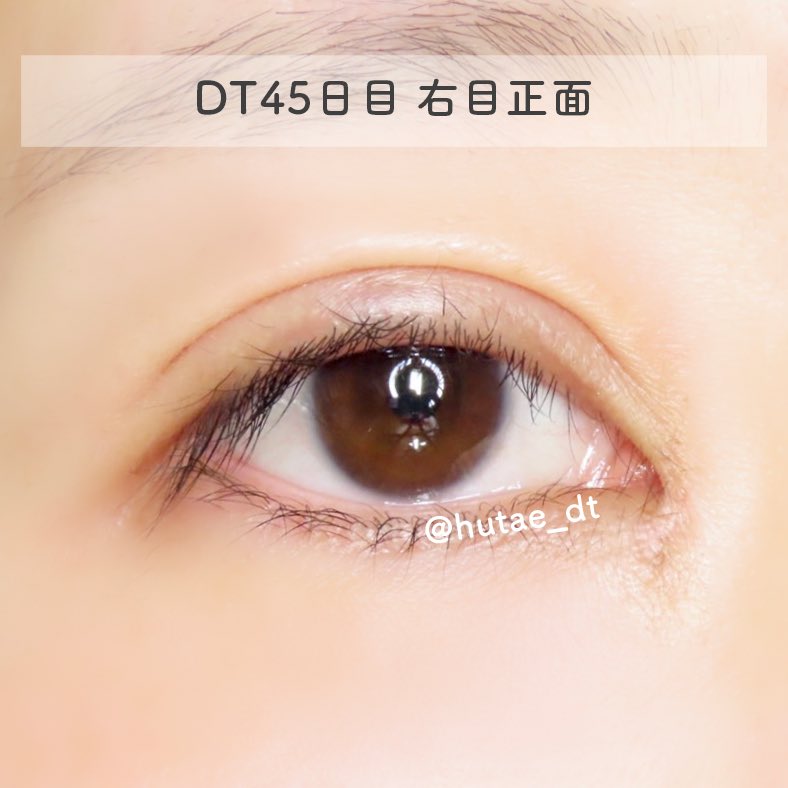 hutae_dt's tweet photo. 【DT45日目】 
くしゃみとか普通にしてたけど、やっぱり目の負担になってる感があるからしないようにしよう💭
外に出かけるときはアレルギーの薬も飲んでます👌(くしゃみは目の負担になりそうだし鼻かむのも皮膚が伸びるので)

#hutae_dt二重DT41〜50 https://t.co/kEPDFoplOi