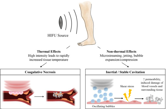 Alan Dardik MD PhD (@adardik) on Twitter photo Congratulations <a href="/andybrahm/">Anand Brahmandam</a> <a href="/YaleVascular/">Yale Vascular Surgery & Endovascular Therapy</a> reviewing use of HIFU in #atherosclerosis #PAD in <a href="/JVS_VascSci/">JVS-Vascular Science</a>! Potential new treatment mechanisms. <a href="/JVascSurg/">Journal of Vascular Surgery</a> <a href="/CurciAAA/">John Curci</a> <a href="/YaleSurgery/">Yale Surgery</a> <a href="/YaleMed/">Yale School of Medicine</a> jvsvs.org/article/S2666-… doi.org/10.1016/j.jvss… jvsvs.org Congratulations <a href="/andybrahm/">Anand Brahmandam</a> <a href="/YaleVascular/">Yale Vascular Surgery & Endovascular Therapy</a> reviewing use of HIFU in #atherosclerosis #PAD in <a href="/JVS_VascSci/">JVS-Vascular Science</a>! Potential new treatment mechanisms. <a href="/JVascSurg/">Journal of Vascular Surgery</a> <a href="/CurciAAA/">John Curci</a> <a href="/YaleSurgery/">Yale Surgery</a> <a href="/YaleMed/">Yale School of Medicine</a> jvsvs.org/article/S2666-… doi.org/10.1016/j.jvss… jvsvs.org
