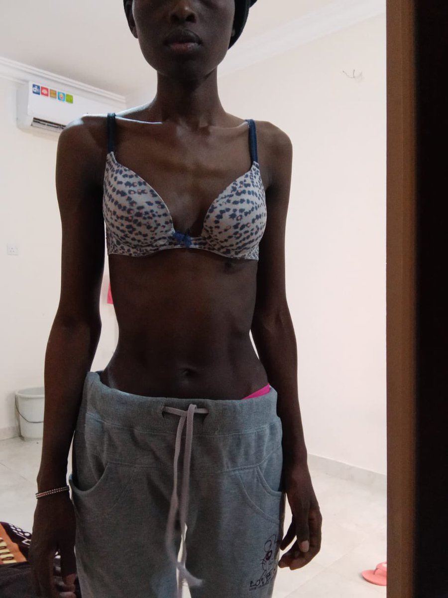 This Kenyan girl called Diana Chepkemoi, Meru University student who went to find work in Saudi Arabia. She went healthy, now she is ENSLAVED. See her transformation. Our embassy has her location and employer's phone but they are sitting pretty waiting for her to die. Sad!
