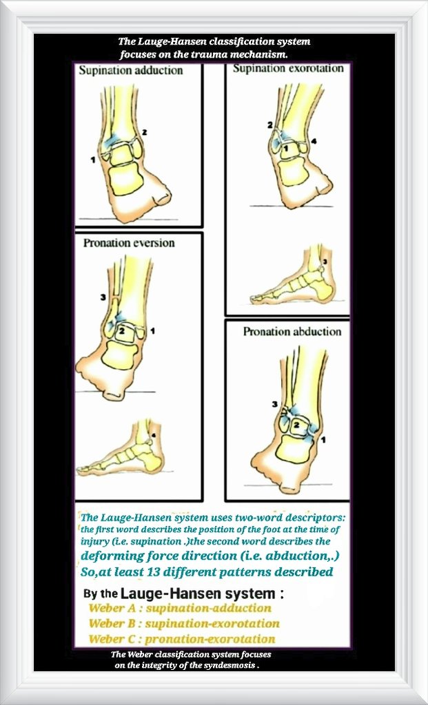 Acute lateral ankle sprain(ALAS) is very common injury,but basedon recent published article,25 different classifications found for these injuries! sciencedirect.com/science/articl…
👉Combining simplicity of Weber with  trauma mechanism of Lauge-Hansen help  to stage ankleinjuries correctly