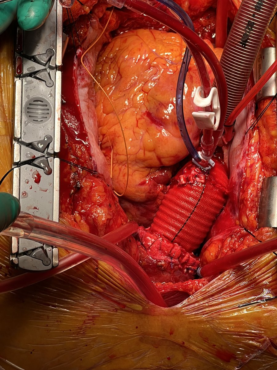 Did not want to leave it hanging without the completion pics of ascending aortic repair <a href="/AorticSurgeonMD/">Konstadinos Plestis</a>