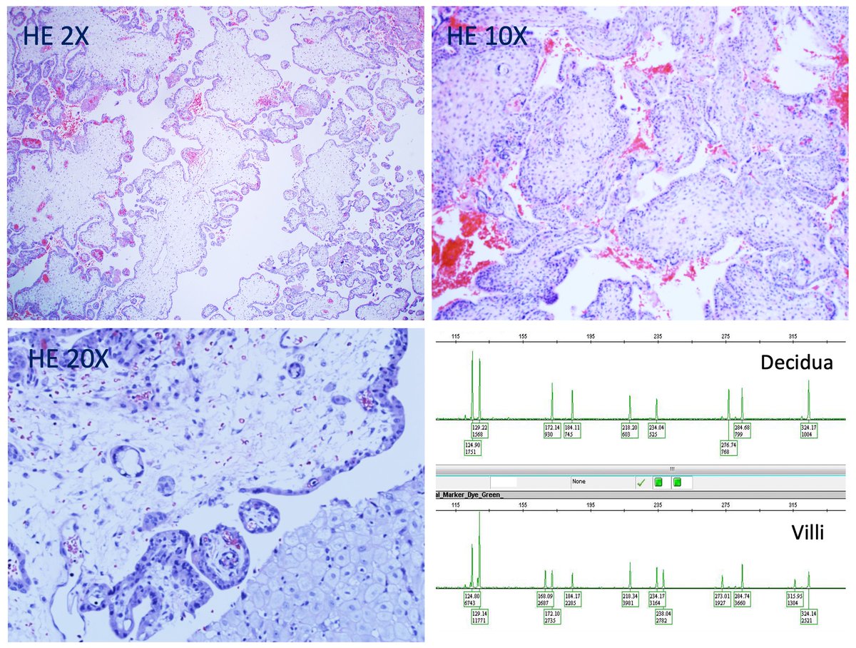 Hui2Pei's tweet photo. 31 year-old woman presenting with vaginal bleeding and cramping at 13 weeks, followed by passing fetus and placental tissue. STR genotyping (lower right). Pick your diagnosis: A: CHM; B: Dispermic PHM; C: Monospermic PHM; D: Non-molar triploid gestation. https://t.co/j94pSooHxJ https://t.co/s7AqCmxFbV