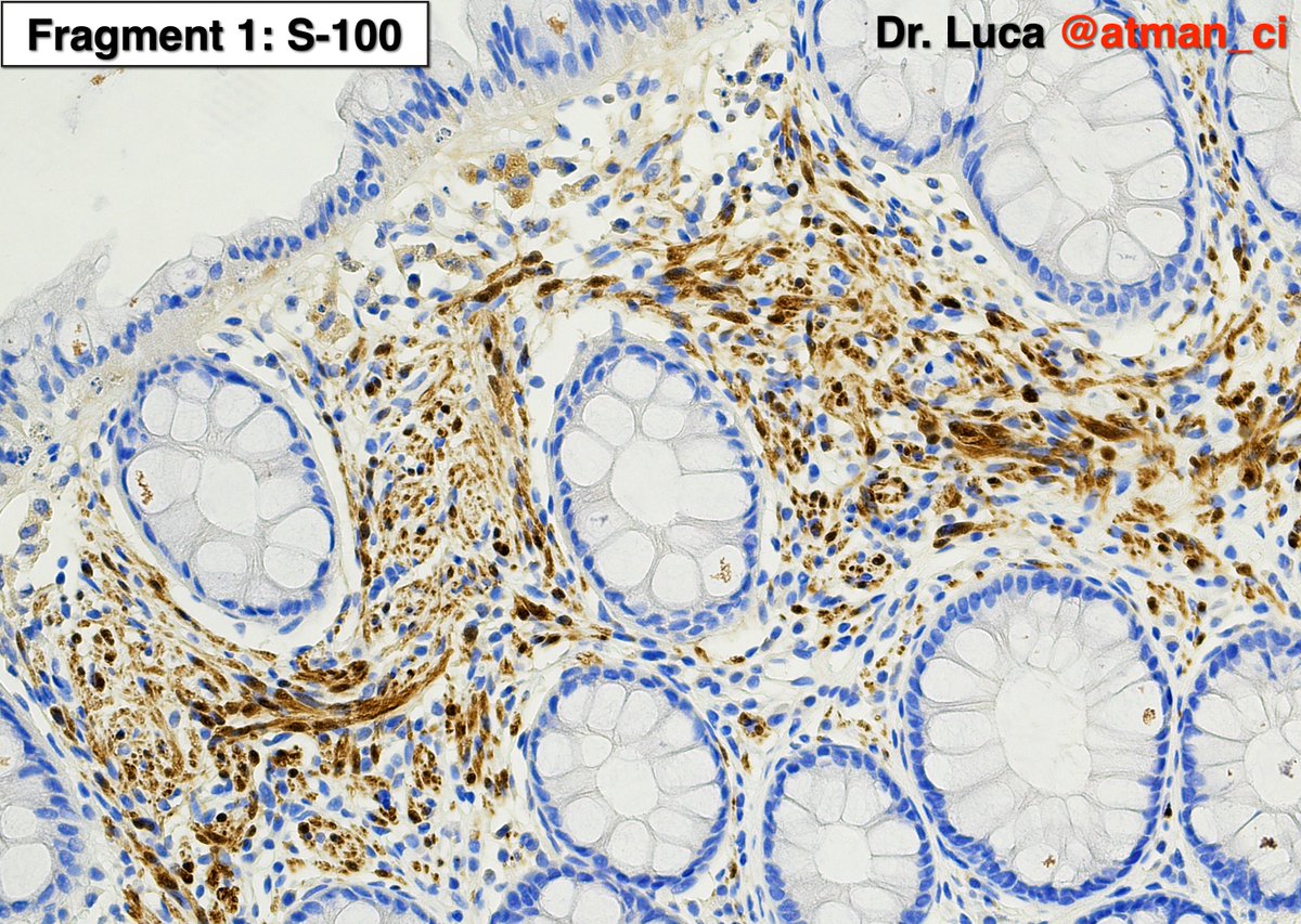 atman_ci's tweet photo. Excellent! Biopsy 1: Schwann cell hamart. (1° fr); HP with perineurioma (2° fr); no syndromes @NeoCrazee @LoboAnandi @shahidi_hossein @pembeoltulu @rajipath @GIJamesMD @vi_monappa @girlscouter @path_girl88 @DrMarkOng @DrBMcGinn @SumantaDas_7 @karaniwakagotho #PathTwittter #GIpath https://t.co/onAK7QtjHR