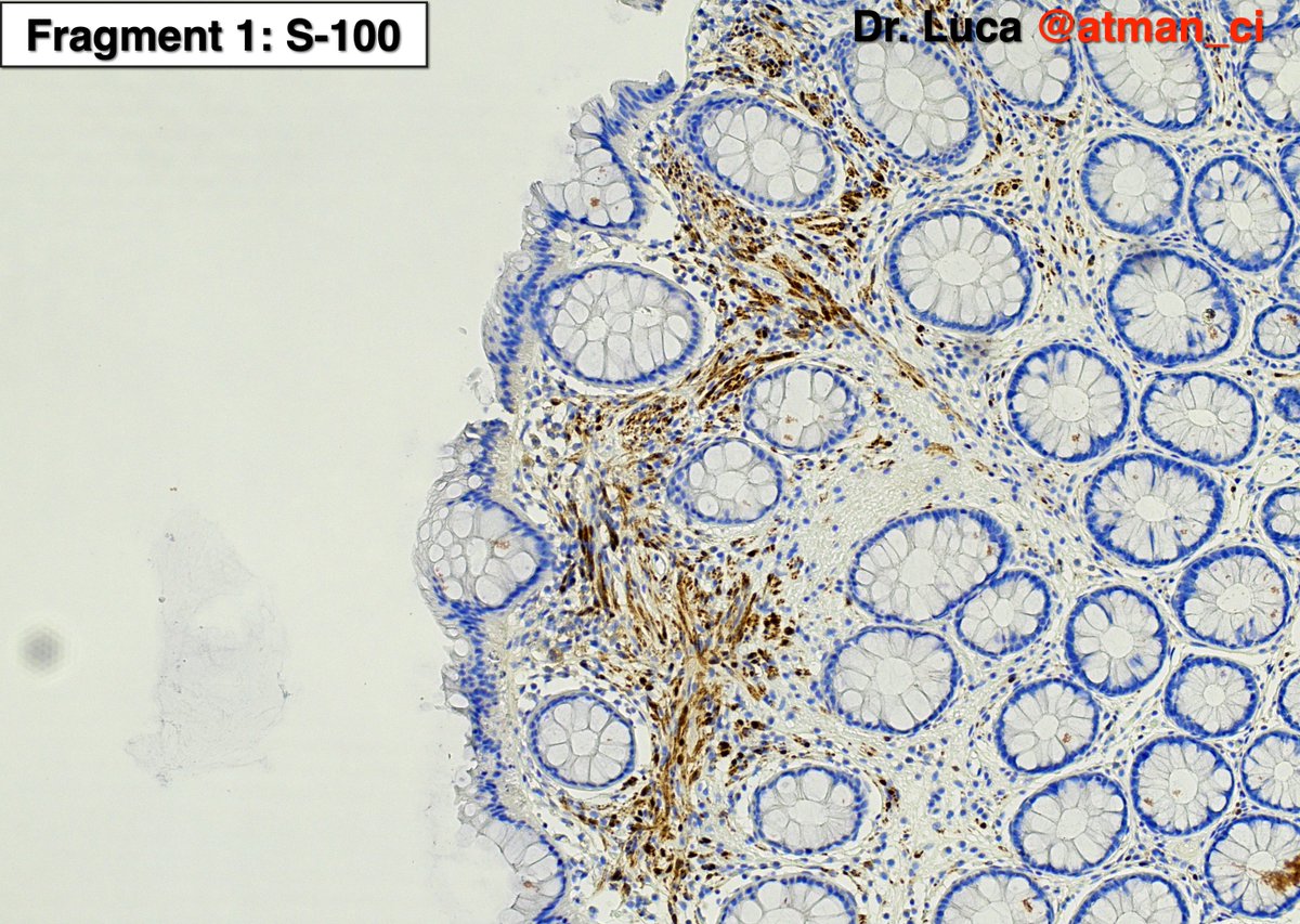 atman_ci's tweet photo. Excellent! Biopsy 1: Schwann cell hamart. (1° fr); HP with perineurioma (2° fr); no syndromes @NeoCrazee @LoboAnandi @shahidi_hossein @pembeoltulu @rajipath @GIJamesMD @vi_monappa @girlscouter @path_girl88 @DrMarkOng @DrBMcGinn @SumantaDas_7 @karaniwakagotho #PathTwittter #GIpath https://t.co/onAK7QtjHR