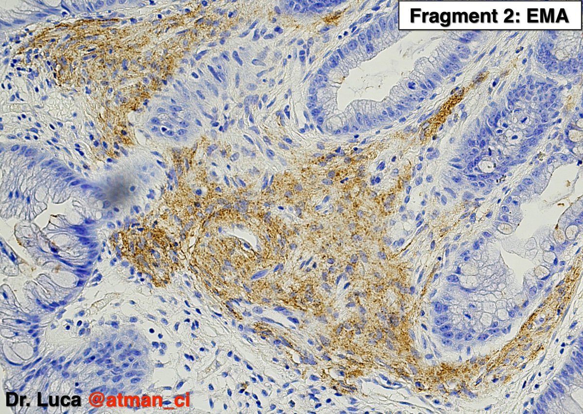 atman_ci's tweet photo. Excellent! Biopsy 1: Schwann cell hamart. (1° fr); HP with perineurioma (2° fr); no syndromes @NeoCrazee @LoboAnandi @shahidi_hossein @pembeoltulu @rajipath @GIJamesMD @vi_monappa @girlscouter @path_girl88 @DrMarkOng @DrBMcGinn @SumantaDas_7 @karaniwakagotho #PathTwittter #GIpath https://t.co/onAK7QtjHR
