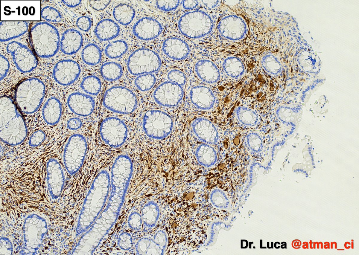 atman_ci's tweet photo. Biopsy 2: ganglioneuroma and an incredible magic trick, the levitation of the glass slide! @NeoCrazee @LoboAnandi @shahidi_hossein @pembeoltulu @rajipath @GIJamesMD @vi_monappa @girlscouter @path_girl88 @DrMarkOng @DrBMcGinn @SumantaDas_7 @karaniwakagotho #PathTwittter #GIpath https://t.co/75aWtyf5Qj