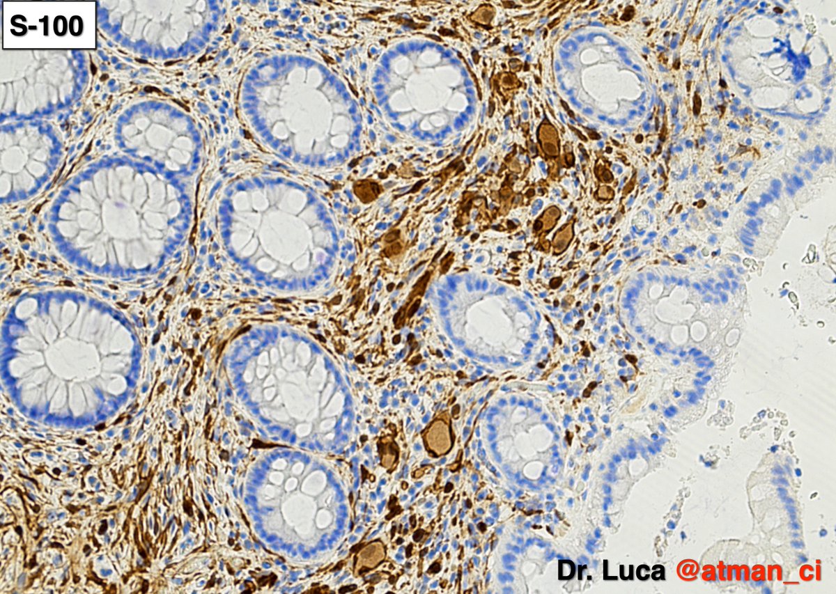 atman_ci's tweet photo. Biopsy 2: ganglioneuroma and an incredible magic trick, the levitation of the glass slide! @NeoCrazee @LoboAnandi @shahidi_hossein @pembeoltulu @rajipath @GIJamesMD @vi_monappa @girlscouter @path_girl88 @DrMarkOng @DrBMcGinn @SumantaDas_7 @karaniwakagotho #PathTwittter #GIpath https://t.co/75aWtyf5Qj