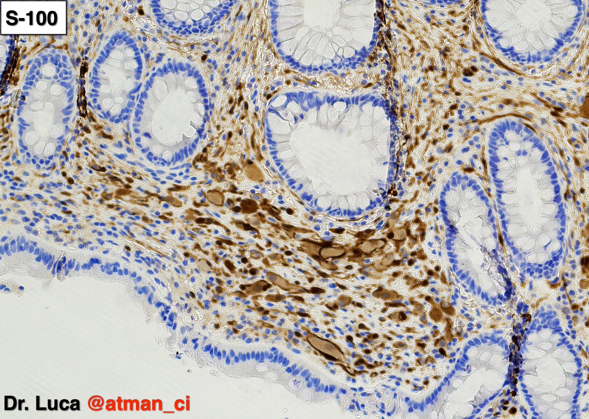 atman_ci's tweet photo. Biopsy 2: ganglioneuroma and an incredible magic trick, the levitation of the glass slide! @NeoCrazee @LoboAnandi @shahidi_hossein @pembeoltulu @rajipath @GIJamesMD @vi_monappa @girlscouter @path_girl88 @DrMarkOng @DrBMcGinn @SumantaDas_7 @karaniwakagotho #PathTwittter #GIpath https://t.co/75aWtyf5Qj