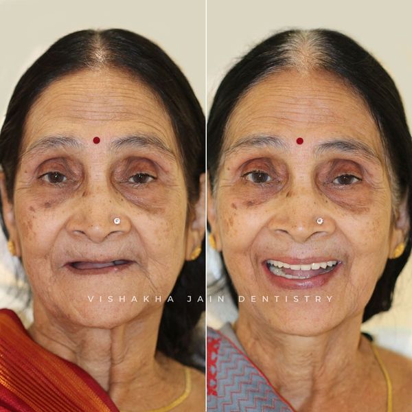 ClinicIndore's tweet photo. Efficient dental treatments at Seraphic bring out happy smiles with full mouth fix denture treatment . Visit the most advaced dental clinic in central India.
Visit: https://t.co/78Vbg4QTxc

Call us/WhatsApp - +919993384941

#fullmouthfixdenture #dentalimplants #zygomaticimplants https://t.co/XxyEWcYPdI