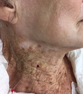 toupassada__'s tweet photo. Essa imagem publicada em artigo do JEADV, de mulher de 92 anos que usava protetor solar na face, mas não no pescoço. Reflitam. https://t.co/KDkKIa17DC