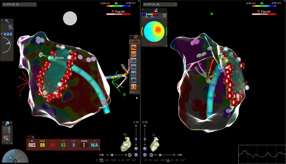Higher power in Goettingen-the QDot finally arrived <a href="/yourUMG/">Universitätsmedizin Göttingen (UMG)</a>. Looking forward to share a piece of cake after 4 min RF time with  <a href="/Helge_Haarmann/">PD Dr. med. Helge Haarmann</a>, <a href="/BengelPhilipp/">Philipp Bengel</a>, <a href="/Phiso_de/">Philipp Sommer</a>, <a href="/chris_sohns/">Christian Sohns</a>, <a href="/DavidDuncker/">David Duncker</a>, <a href="/YoungDgk/">Young DGK</a>, <a href="/AGEP_DGK/">AGEP</a>, <a href="/SimonWestermeye/">Simon Westermeyer</a>