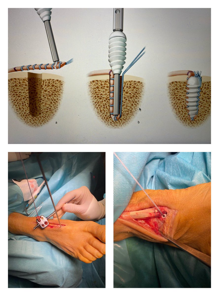 ClinicaCEMTRO's tweet photo. 🦶🏼Reinserción por rotura de #TendónTibial anterior contralateral con la técnica #CorticalButton y #TobilloBiotenodesis @Arthrex
🧑🏻⚕️Vía @DrSergiohorte , miembro de la Ud. Pie y Tobillo de #ClínicaCEMTRO https://t.co/WOeaqPPtA6