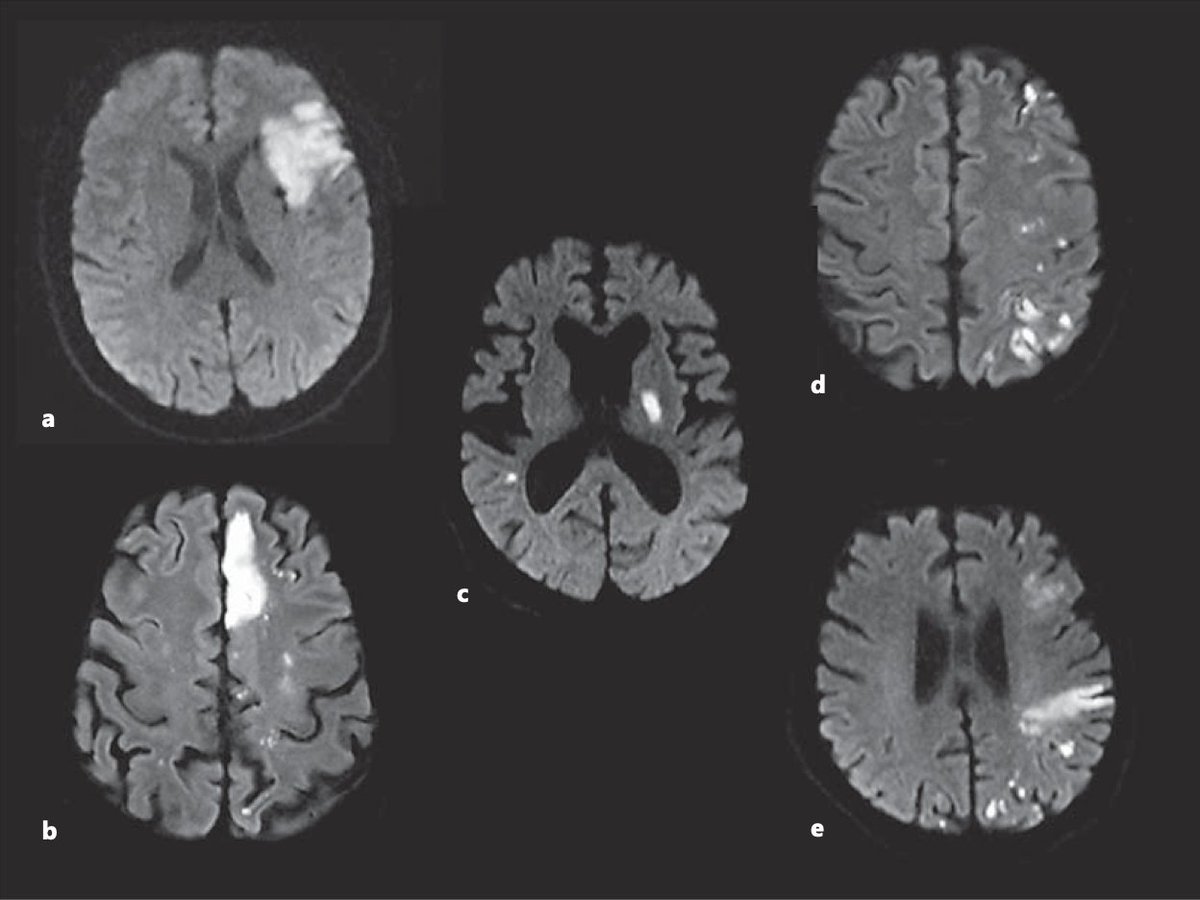 When to have heighten suspicion for cancer-related ischemic stroke? - ESUS - 3-territory DWI infarct pattern - Smoker (previous or current) - ⬆️ d-dimer (>3) - ⬇️ Hgb - Embolic stroke on DOAC (compliant and correct dose) #neurotwitter #stroke
