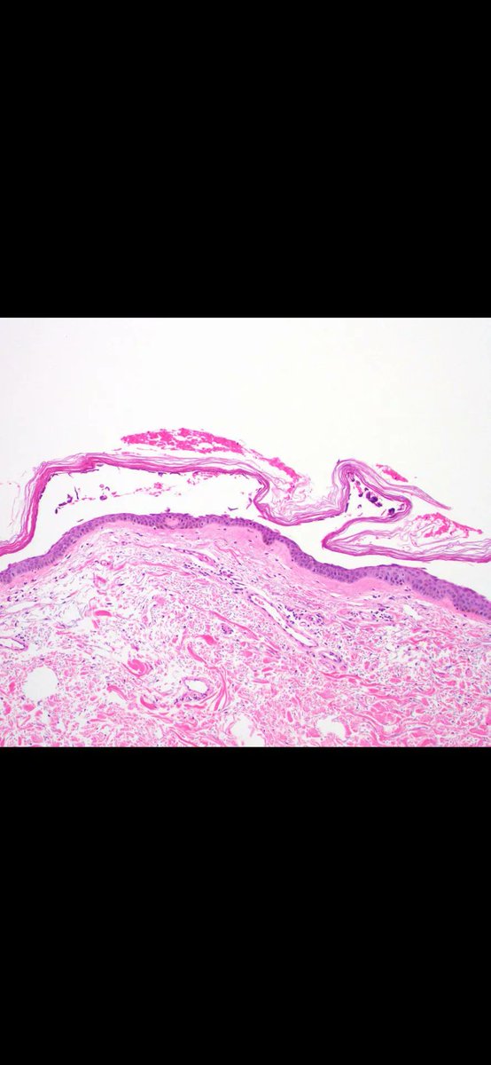 JMGardnerMD's tweet photo. Poor kiddo w diffuse skin sloughing &amp; blistering. Skin biopsy of blister - what level is the split? Your diagnosis? Reply then check answer here: https://t.co/jKXb5PRzyh. #pathology #pathologists #pathTwitter #dermpath #dermatology #dermatologia #dermtwitter https://t.co/Rfjn5ZcmA8