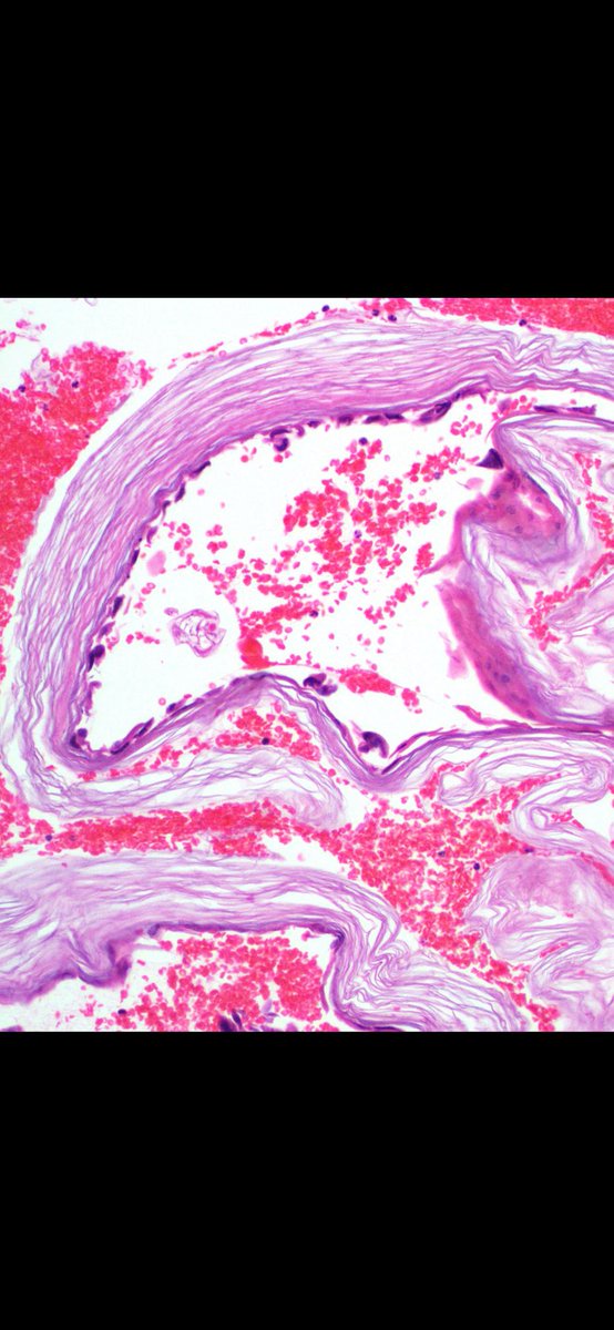 JMGardnerMD's tweet photo. Poor kiddo w diffuse skin sloughing &amp; blistering. Skin biopsy of blister - what level is the split? Your diagnosis? Reply then check answer here: https://t.co/jKXb5PRzyh. #pathology #pathologists #pathTwitter #dermpath #dermatology #dermatologia #dermtwitter https://t.co/Rfjn5ZcmA8