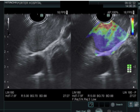 EUSandEndoscopy's tweet photo. Nice #EUSimages of EUSelastrography & #EUSFNB of large malignant mediastinal lymph node at Center for Advanced Therapeutic Endoscopy #PorterHospital Denver CO @DouglasAdlerMD https://t.co/DZJgcpyuZ8