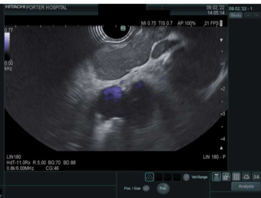 EUSandEndoscopy's tweet photo. Nice #EUSimages of EUSelastrography & #EUSFNB of large malignant mediastinal lymph node at Center for Advanced Therapeutic Endoscopy #PorterHospital Denver CO @DouglasAdlerMD https://t.co/DZJgcpyuZ8