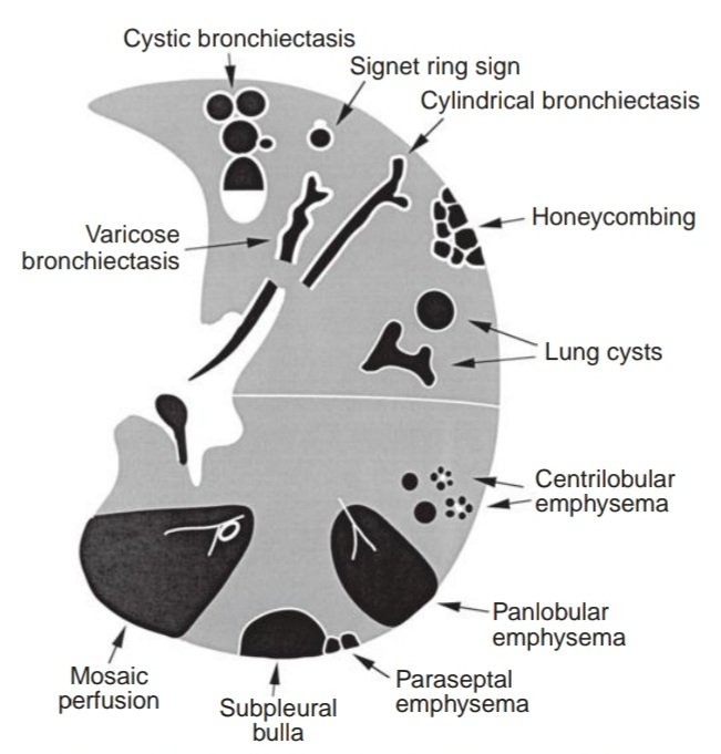 Bronchiectasis. The arrows show cylindrical bronchiectasis spread to... |  Download Scientific Diagram