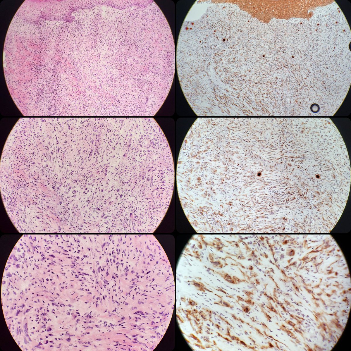 drvitalyt's tweet photo. Mohs surgery frozen section of the day - Spindle cell squamous cell carcinoma stained with H&amp;E and AE1/AE3. 

Immunostains for skin cancers such as AE1/AE3 for squamous cell carcinoma allow for superior interpretation of Mohs frozen sections compared to H&amp;E alone. https://t.co/EmUIaoxKNR