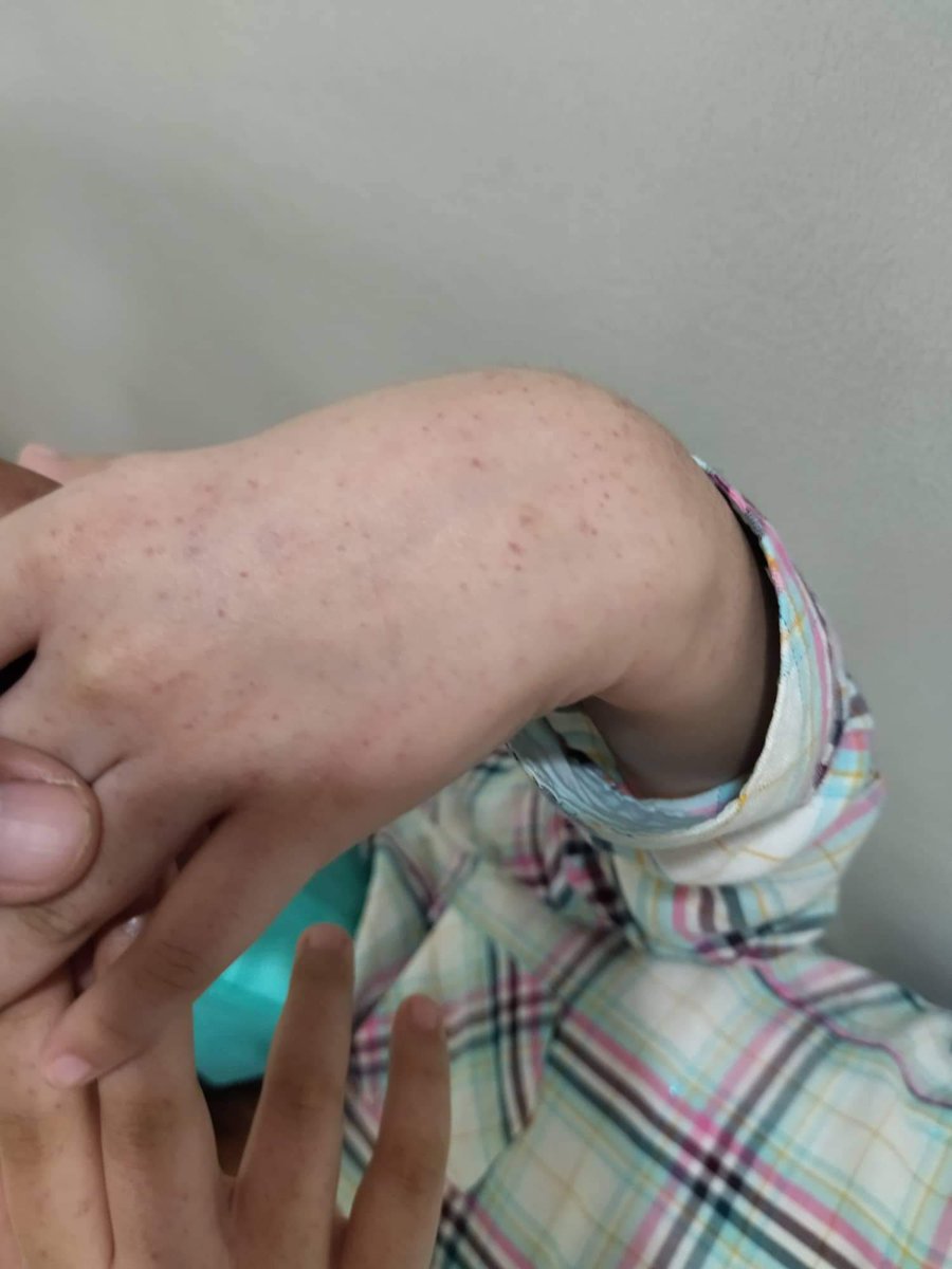 mona_monakko's tweet photo. ‼️ASKING FOR HELP‼️
Hello everyone I know this isn't art related like usual but this is something close to my heart and im in desperate need of help for my little sister. She was diagnosed yesterday for having Idiopathic thrombocytopenic purpura... 1/3? https://t.co/MmfBLme7Br