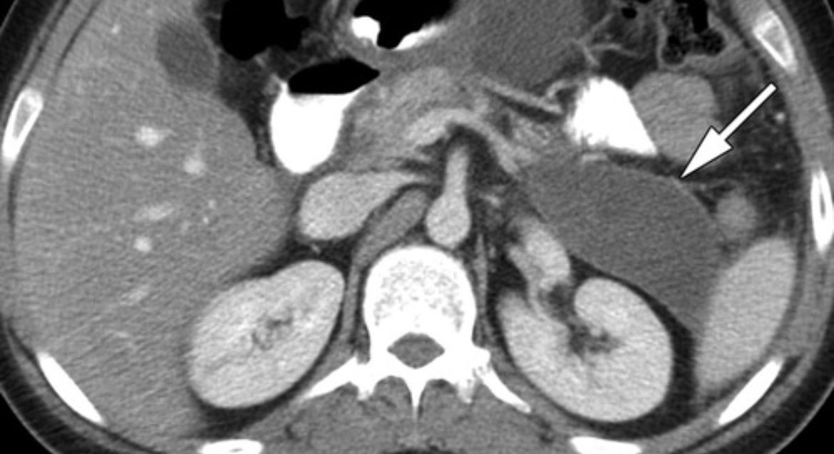 Patient with weight loss and changes in stool. Bowel loop obstruction, infection, or pancreatic lesion? Via RadioGraphics #raded #radiology #meded #foamrad #usmle #radres