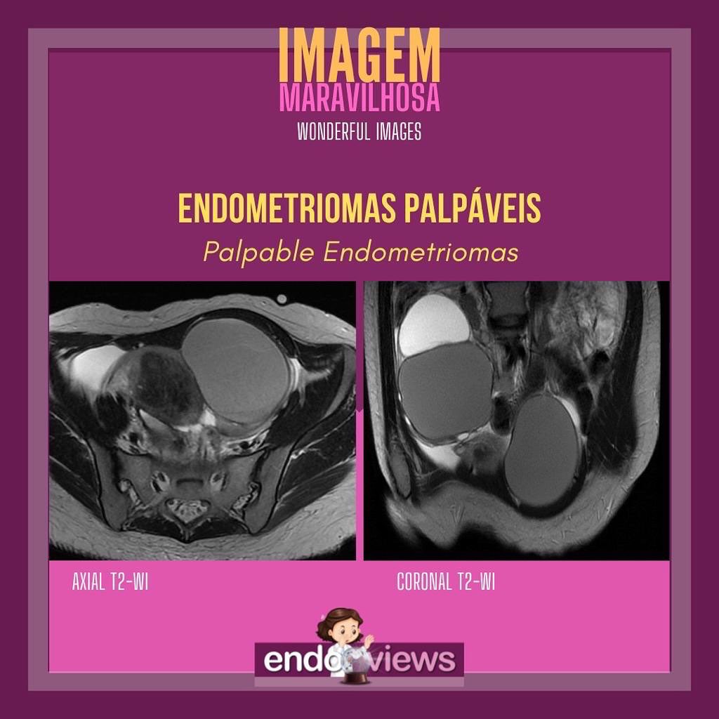 endoviews's tweet photo. Palpable endometriomas
Dra. Luciana Chamié - @lucianachamiec1
Dra. Izabela Pires Franco - @izabelapfranco
Dra. Alice Brandão
🔮Endoviews. O seu banco de imagem em endometriose. Endoviews. Your image database on endometriosis. https://t.co/CdqMtHBVZD