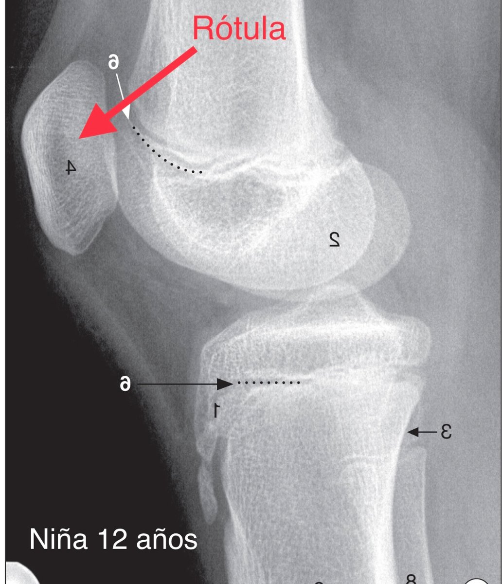 La #rótula (#patela) comienza su proceso de osificación entre los 3 y 5 años. Por lo tanto, en las radiografías (RX) de niños de esa edad no se visualiza. Imágenes de RX lateral de #rodilla. 
Imagen de Weir y Abrahams. Atlas de anatomía humana por técnicas de imagen
© 2021.