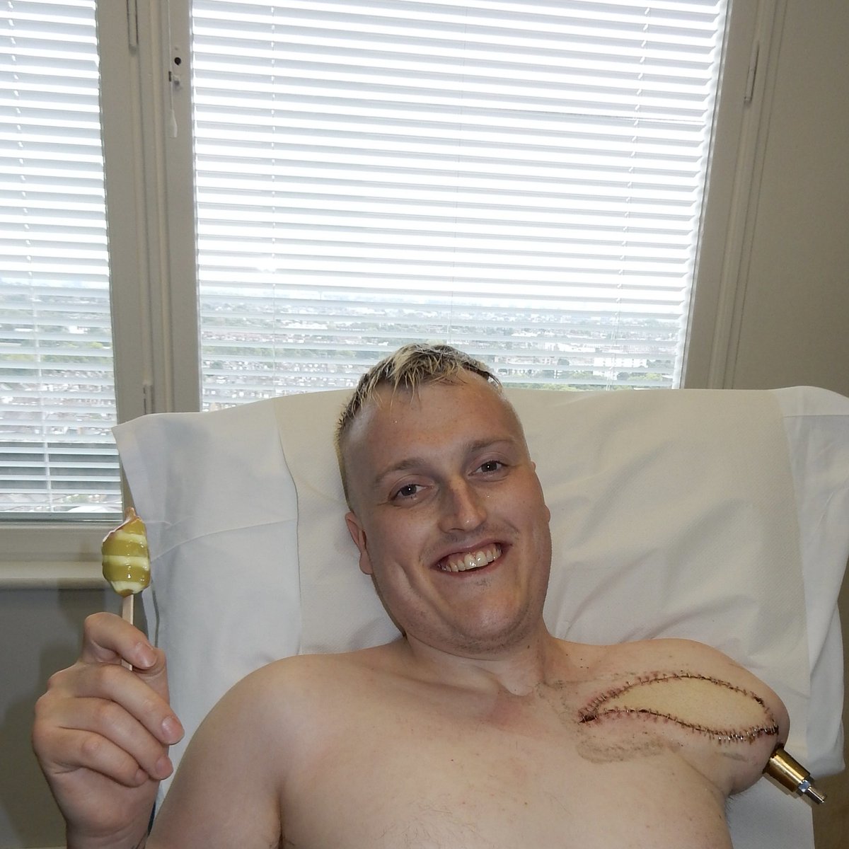 Relimb_UK's tweet photo. An OPL bone anchor and a free flap to provide potential targets to rewire his brachial plexus have resolved his pain and will provide more function from his prosthetic arm…worth an ice cream! https://t.co/orswIe8GTc