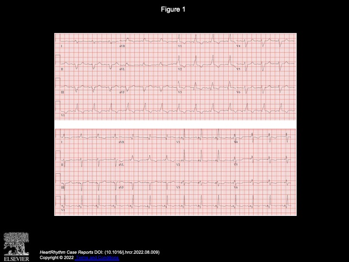 KenXiaoke's tweet photo. Interesting case of RBBB responding to LBBA pacing (fluoroless with Carto mapping) https://t.co/8I8wdlhbBa