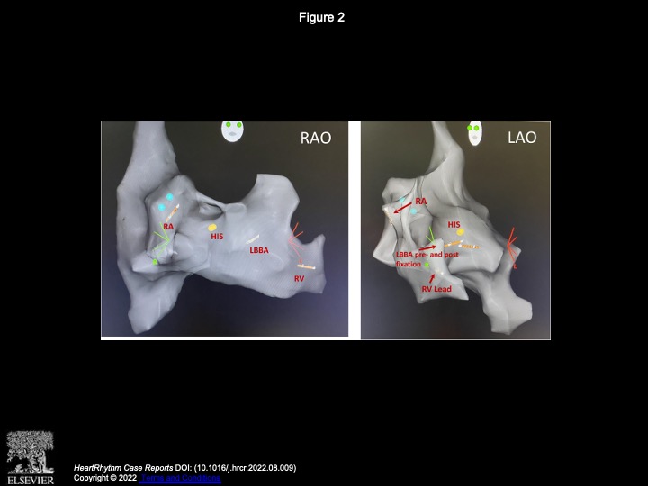 KenXiaoke's tweet photo. Interesting case of RBBB responding to LBBA pacing (fluoroless with Carto mapping) https://t.co/8I8wdlhbBa
