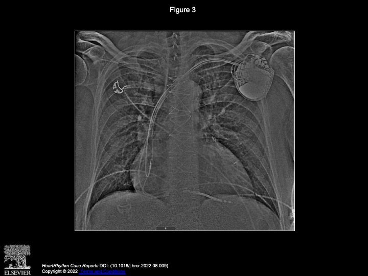 KenXiaoke's tweet photo. Interesting case of RBBB responding to LBBA pacing (fluoroless with Carto mapping) https://t.co/8I8wdlhbBa